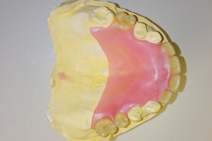 New Dentures Before And After Pictures San Benito TX 78586